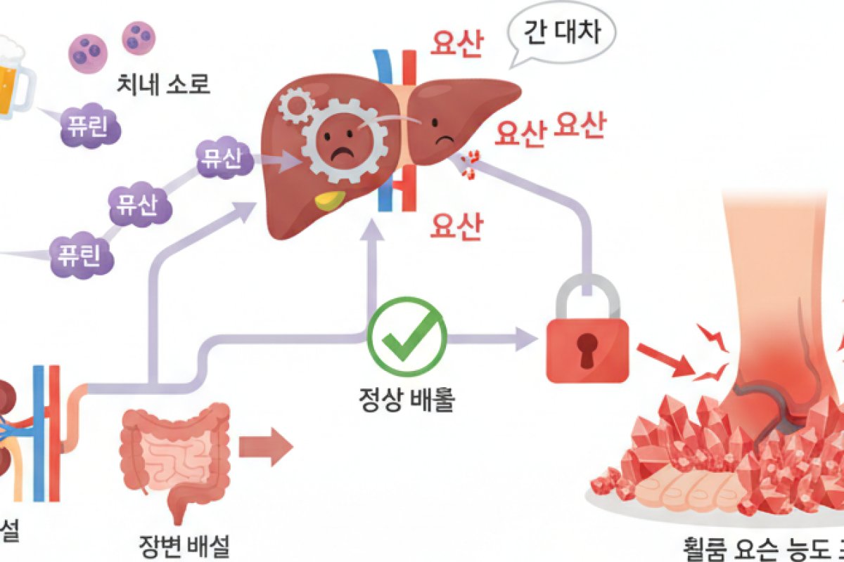 요산 수치와 통풍 발작이 일어나는 신체적 기전